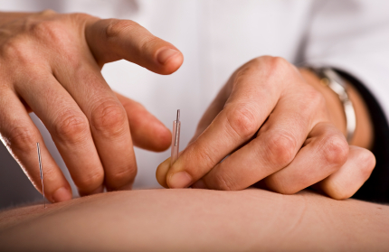 Acupuncture at Maple Leaf Wellness